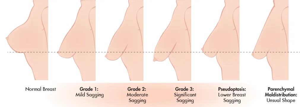 Phân loại ngực bị sa trễ